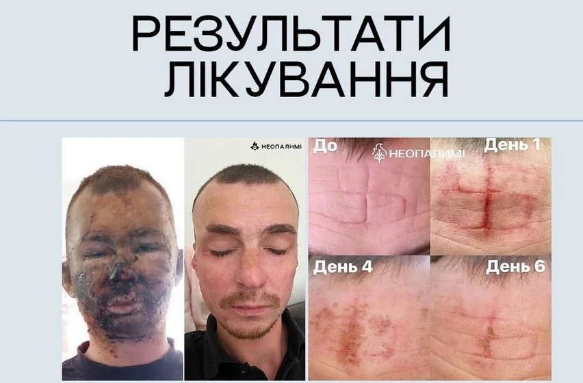 «Неопалимі» у Житомирі: як лікарі-волонтери повертають людям обличчя і життя після війни